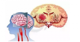 脑血管崩溃前的10个信号，千万别等半身不遂才看到！